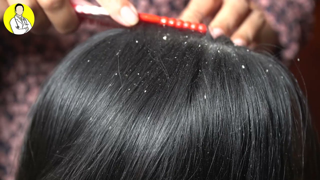 Extreme Damage, Itchy Dry Scalp / Dandruff, Huge Flake Scratching #Shorts