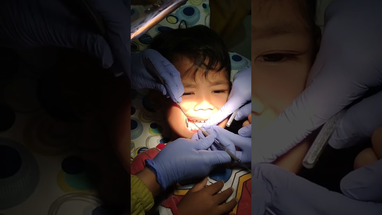 Tembel gigi anak-anak, araya berani. Makanya jangan sering makan permen