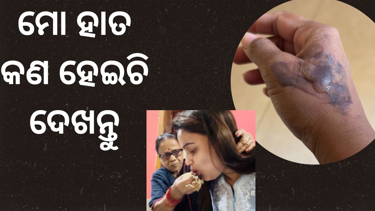 Hand Burn While Cooking| ଦେଖନ୍ତୁ କଣ ହେଇଚି ମୋ ହାତ ର ଅବସ୍ଥା |