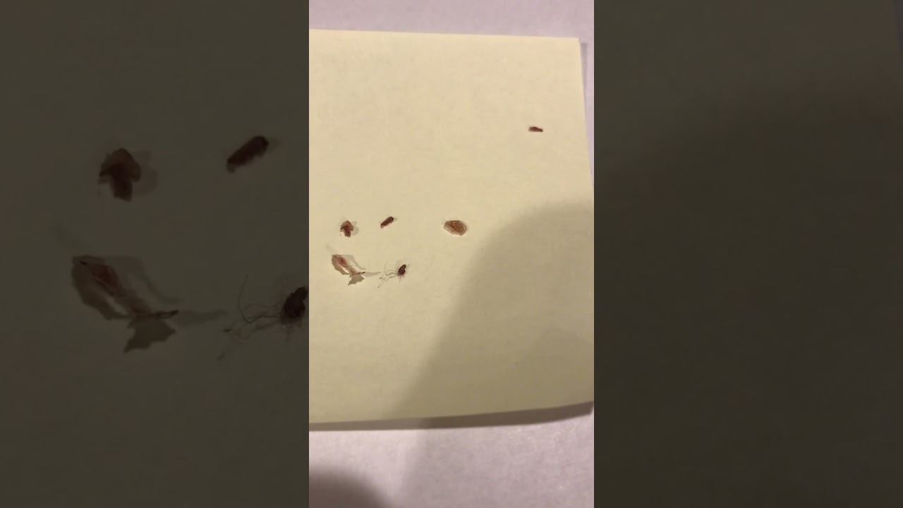 Carpet Beetle Larvae Infested in my skin!￼