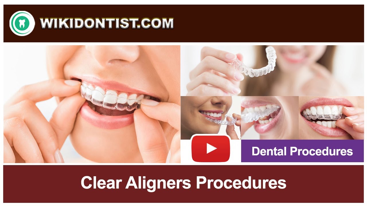 Clear Aligners Procedure