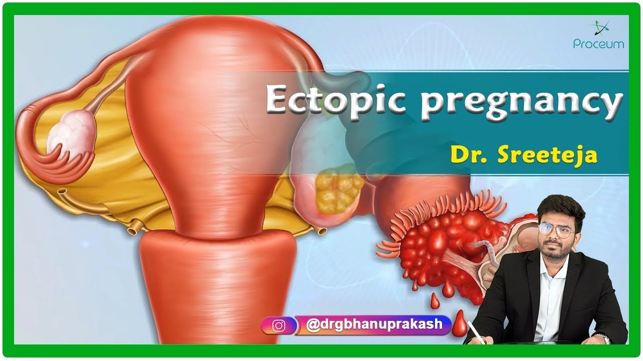 Ectopic Pregnancy : Etiology, Clinical features, Diagnosis, Treatment and Complications : Gynecology