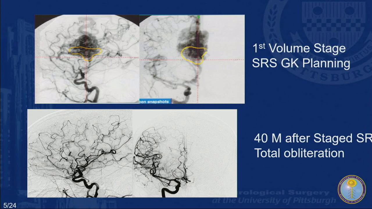 SVIN 2019: Radiosurgery as a Stand-Alone Treatment for High Spetzler Martin Grade AVMs