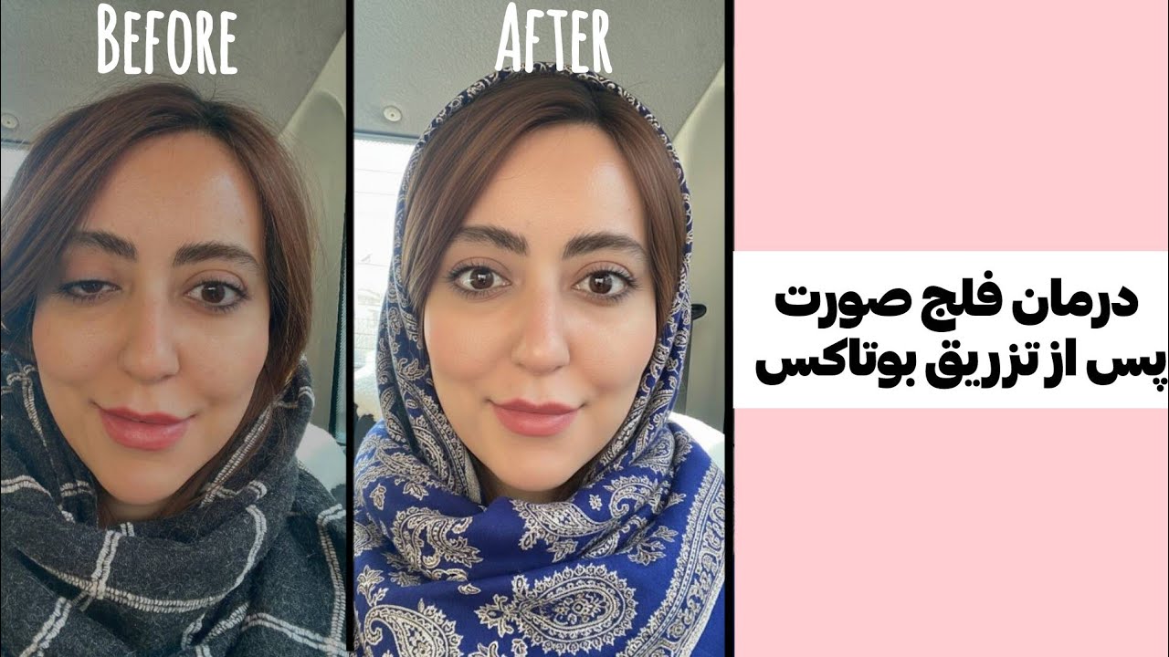 کجی صورت بعد از بوتاکس؟ درمان تخصصی فلج صورت با فیزیوتراپی | نتیجه واقعی
