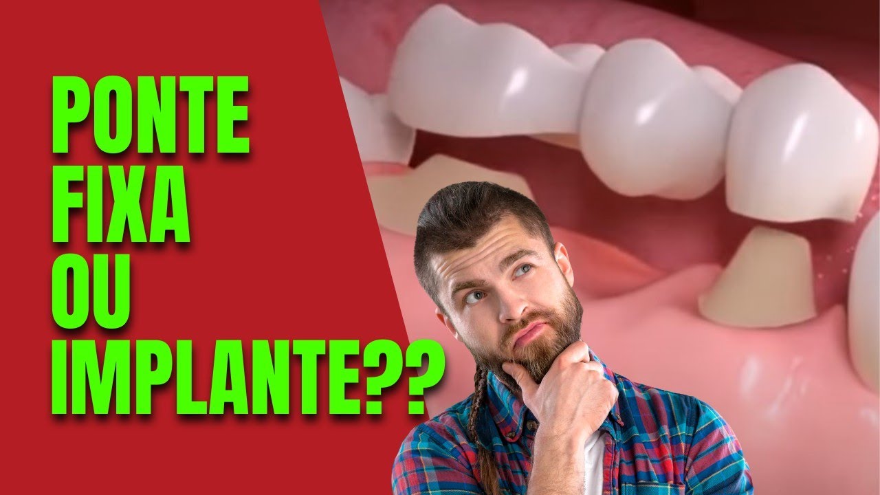 Implantes dentais ou ponte fixa sobre dentes? O que &eacute; melhor?