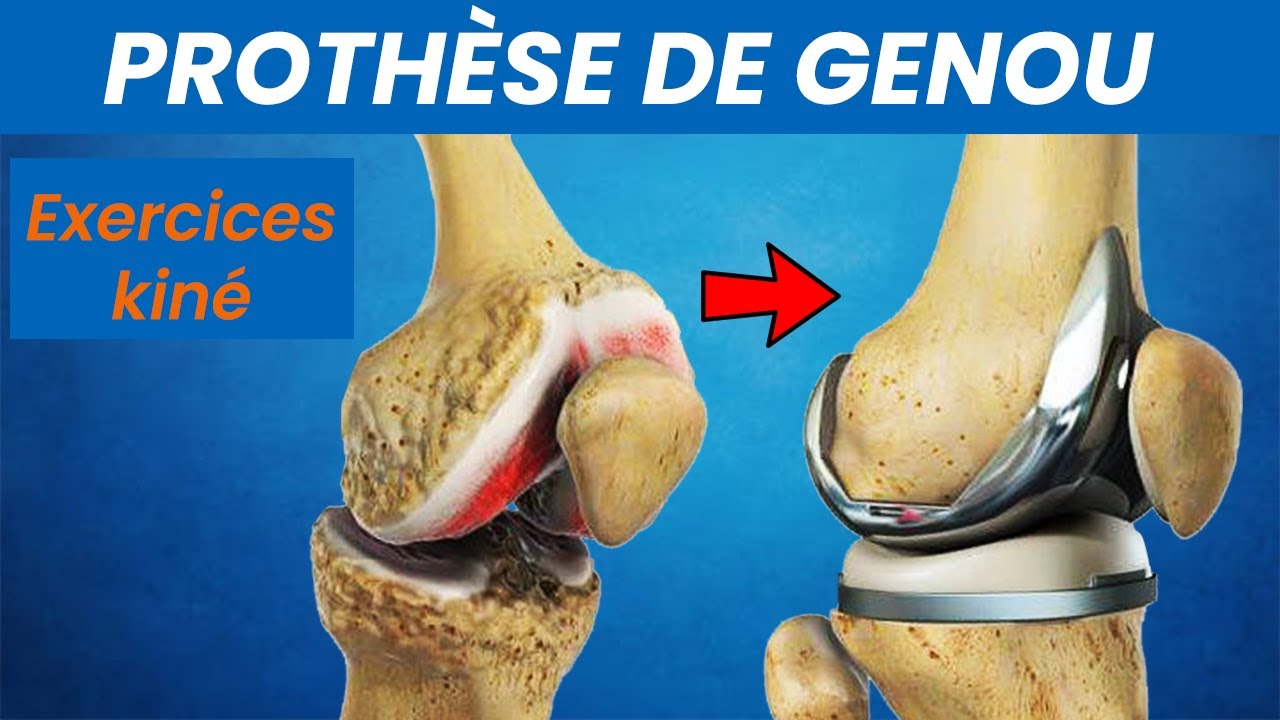 Prothèse de genou : Exercices kiné de rééducation