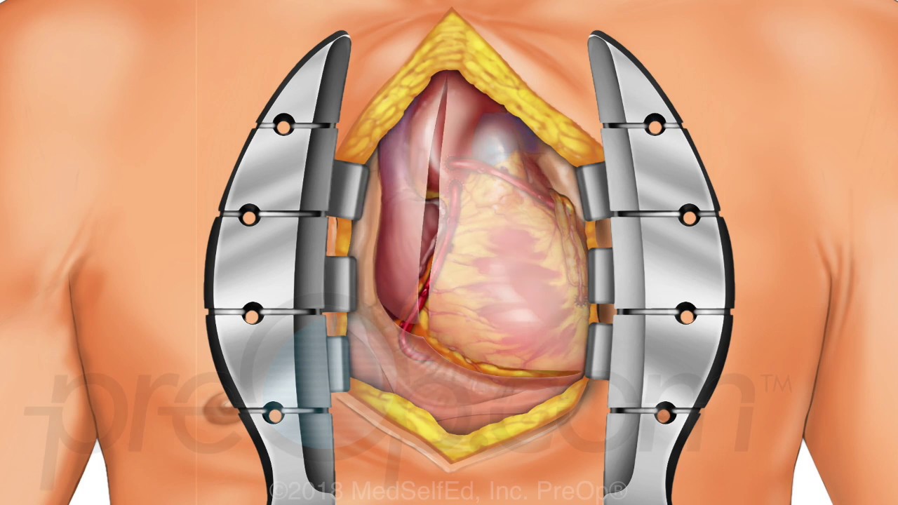 Coronary Artery Bypass Graft (CABG ) Off-Pump PreOp&reg; Patient Education