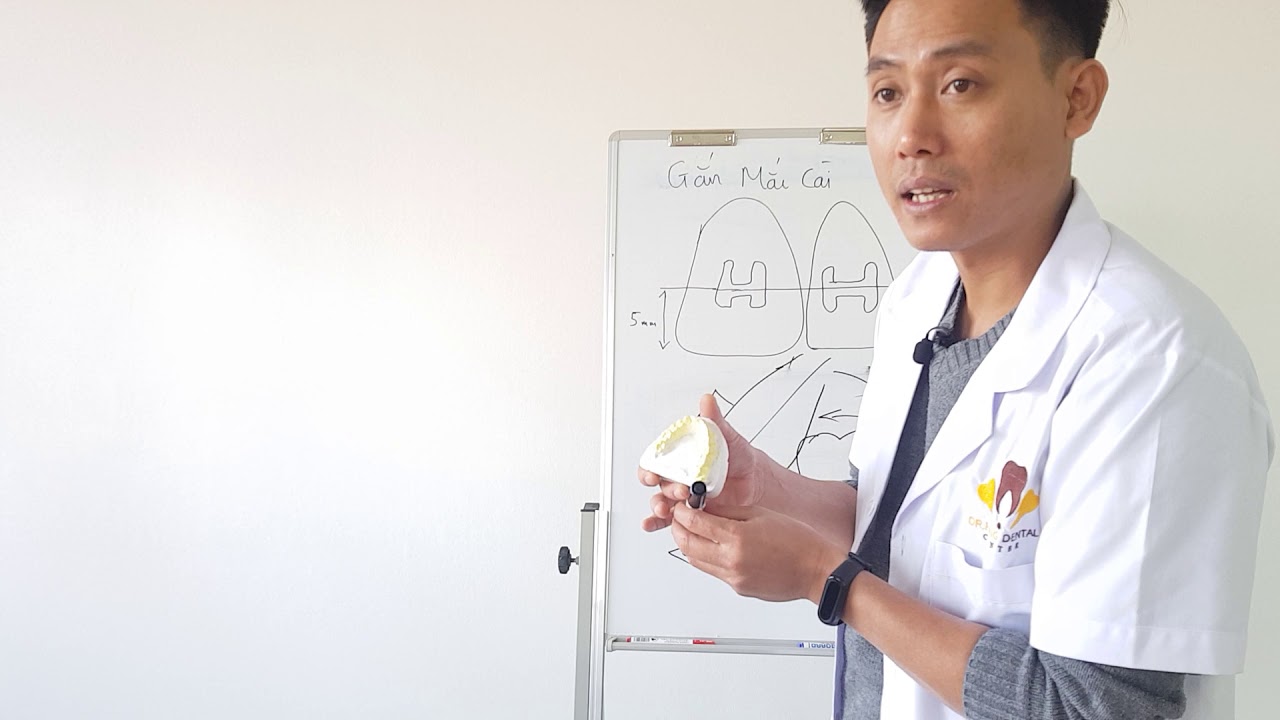 Gắn mắc cài trong chỉnh nha