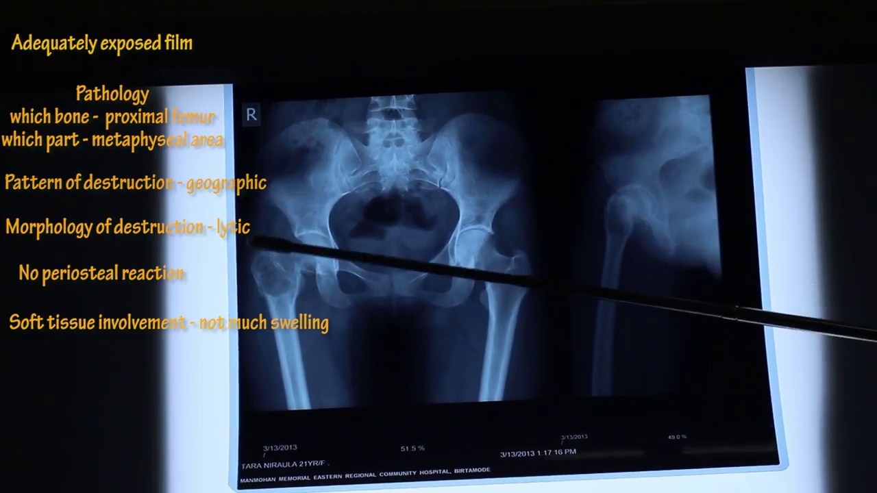HOW TO READ X-RAY PROPERLY IN ORTHOPAEDICS | MADE EASY BY DR. BISHNU POKHAREL | PART 2