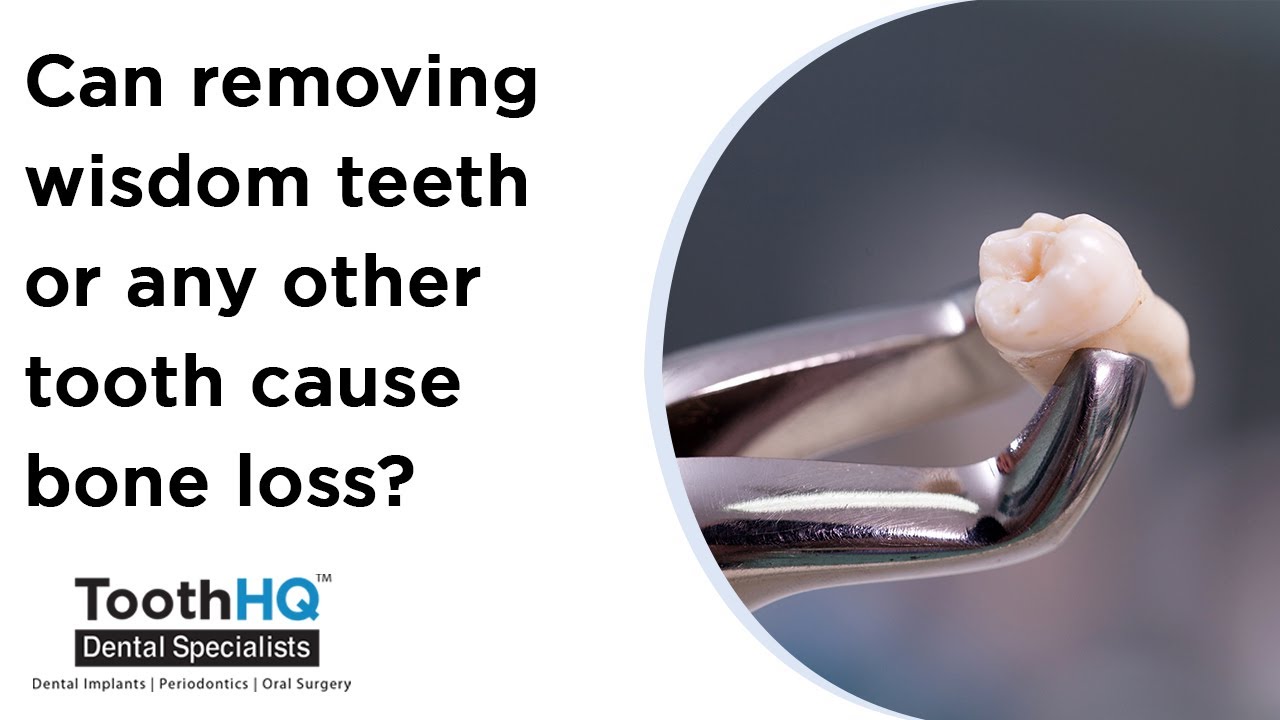 Can removing wisdom teeth or any other tooth cause bone loss? Dr Vadivel, ToothHQ, Dallas Fort Worth