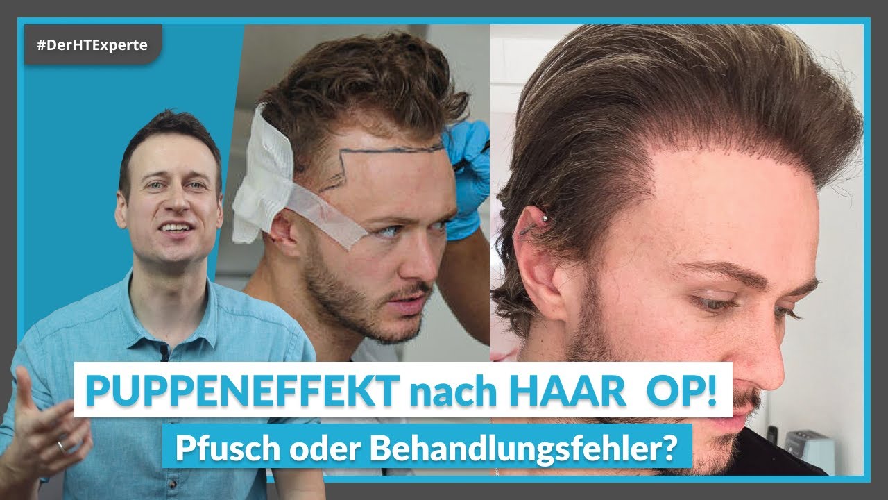 Wie GEFÄHRLICH ist eine Haartransplantation? | RISIKEN & NEBENWIRKUNGEN im Überblick
