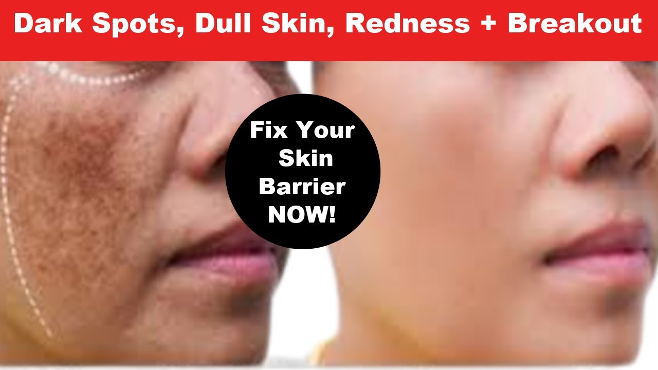 Fix Your Skin Barrier Now! The Best Routine for Redness, Dark Spots & Dull Skin