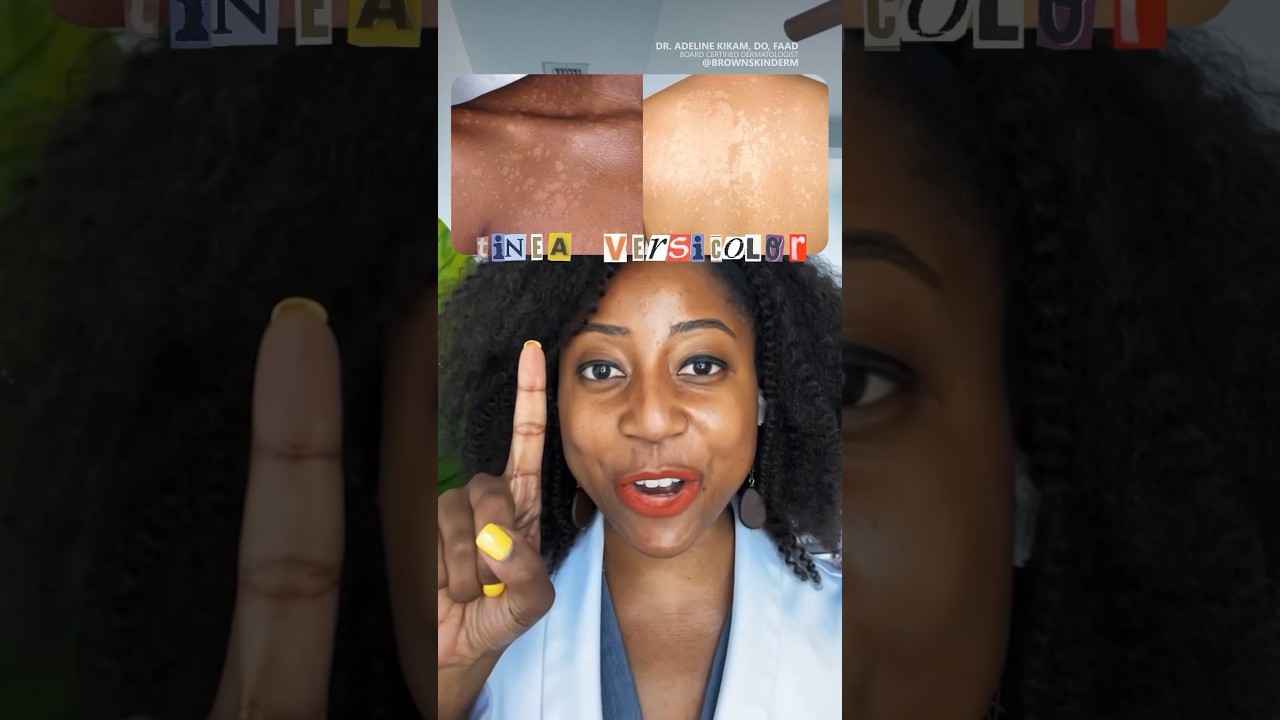 How to Treat Tinea Versicolor #skincare #tineaversicolor