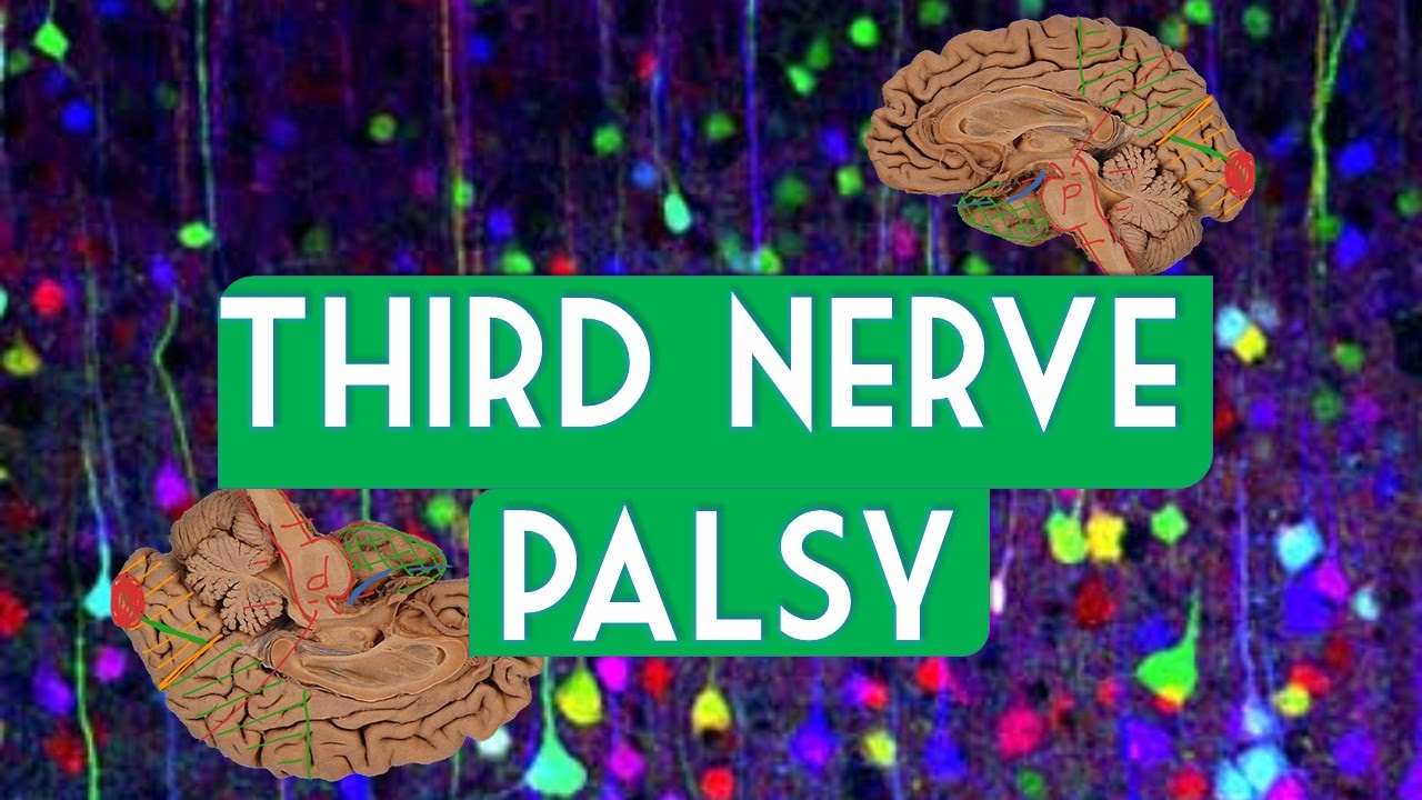 Third nerve palsy
