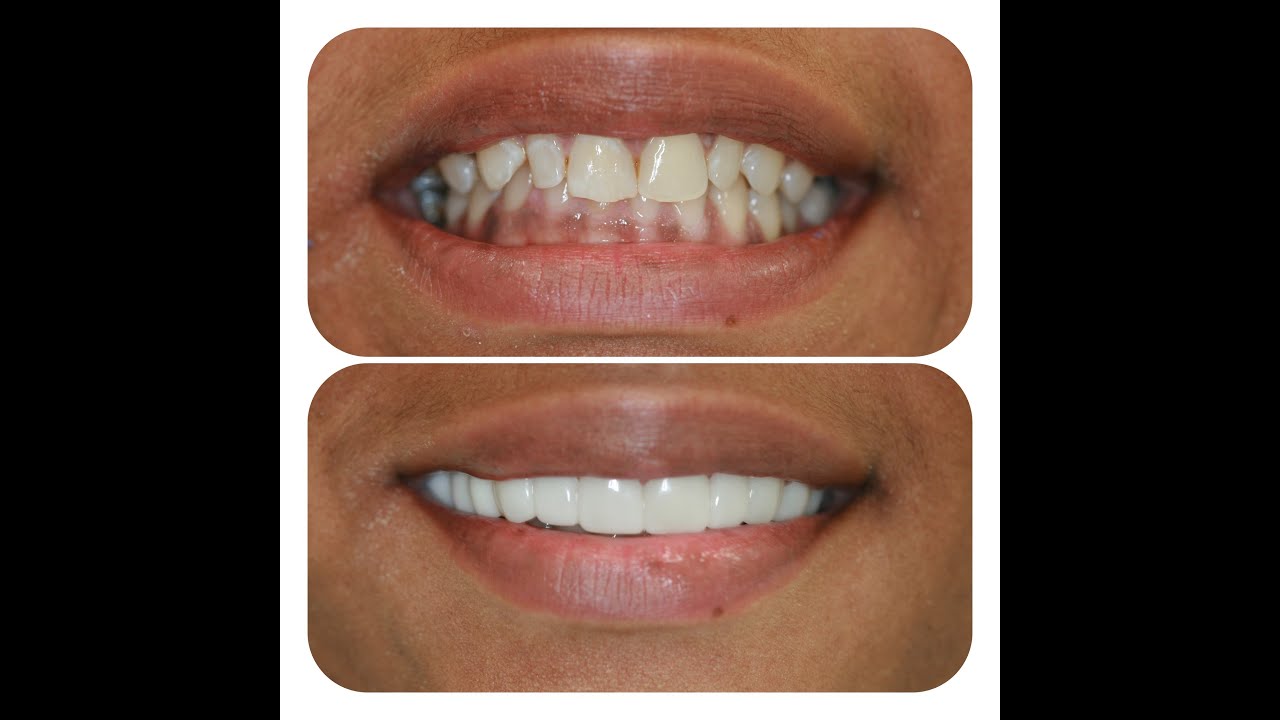 Houston Cosmetic Dentist...White Straight Teeth and No more gaps!  Affordable, Amazing, Functional!