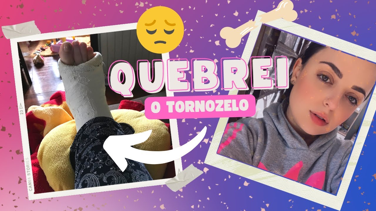 CAI E FRATUREI A FÍBULA 🦴 😢 Quebrei o tornozelo