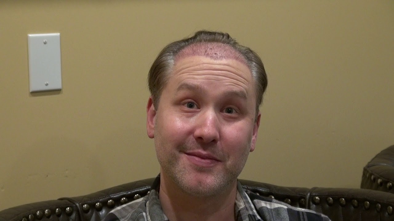 Three Week Follow Up After Hair Line Restoration Surgery by Dr. Diep