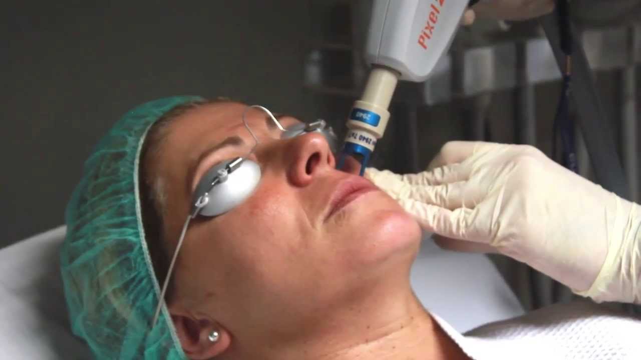 Rejuvenecimiento con Láser de Erbio Fraccionado. Resurfacing en Clínica Esbeltic Model