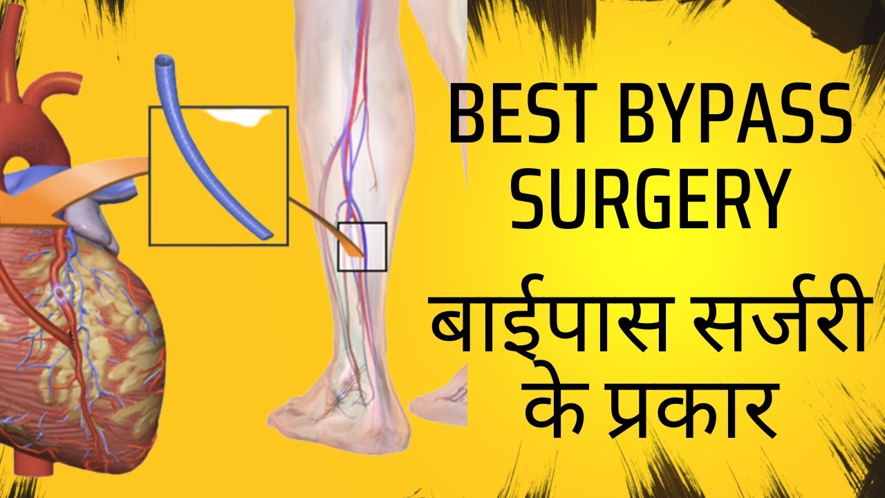बाईपास कितने तरह का होता है? | सबसे अच्छा बाईपास कौनसा है? | Types of bypass | Dr.Pravir Jha