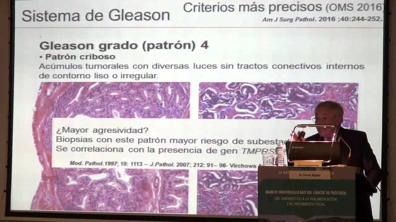 DR. Ferran Algaba ¿Está la clasificación de Gleason pasada de moda? El nuevo sistema pronóstico.