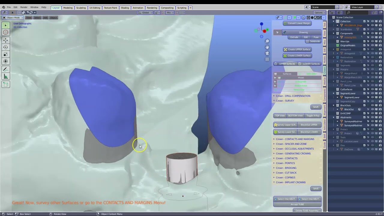 B4D Crown module - Making an implant crown for the lower 35