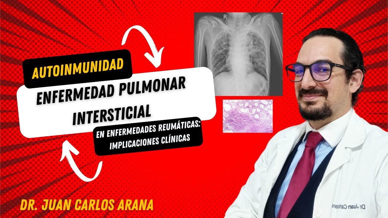 Enfermedad Pulmonar Intersticial en Reumatología