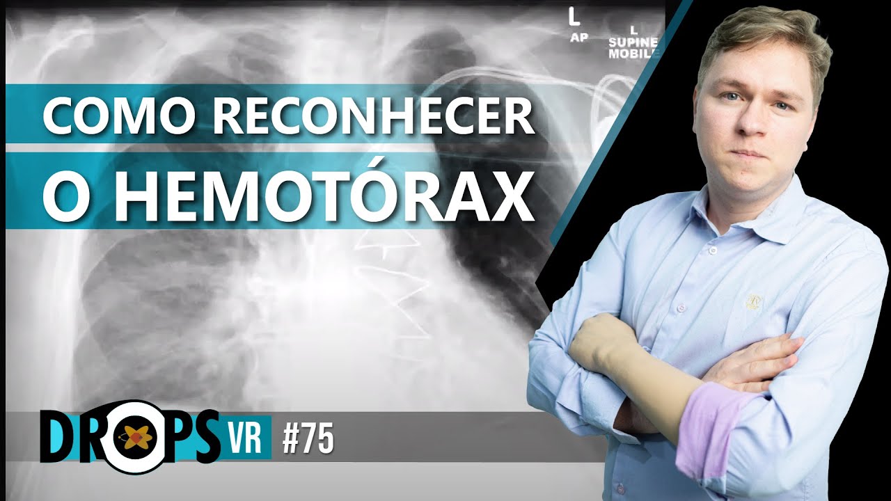 COMO RECONHECER O HEMOT&Oacute;RAX NA RADIOGRAFIA REALIZADA EM DEC&Uacute;BITO DORSAL