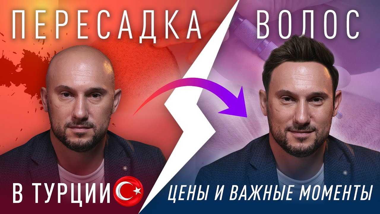 Пересадка волос в Турции. Поехал узнать могу ли пересадить себе волосы.