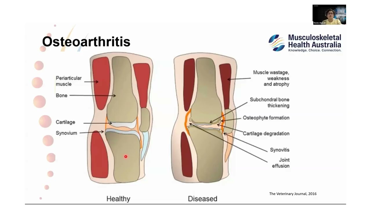 Musculoskeletal Health Awareness Month - The Link Between Heart Disease and Arthritis