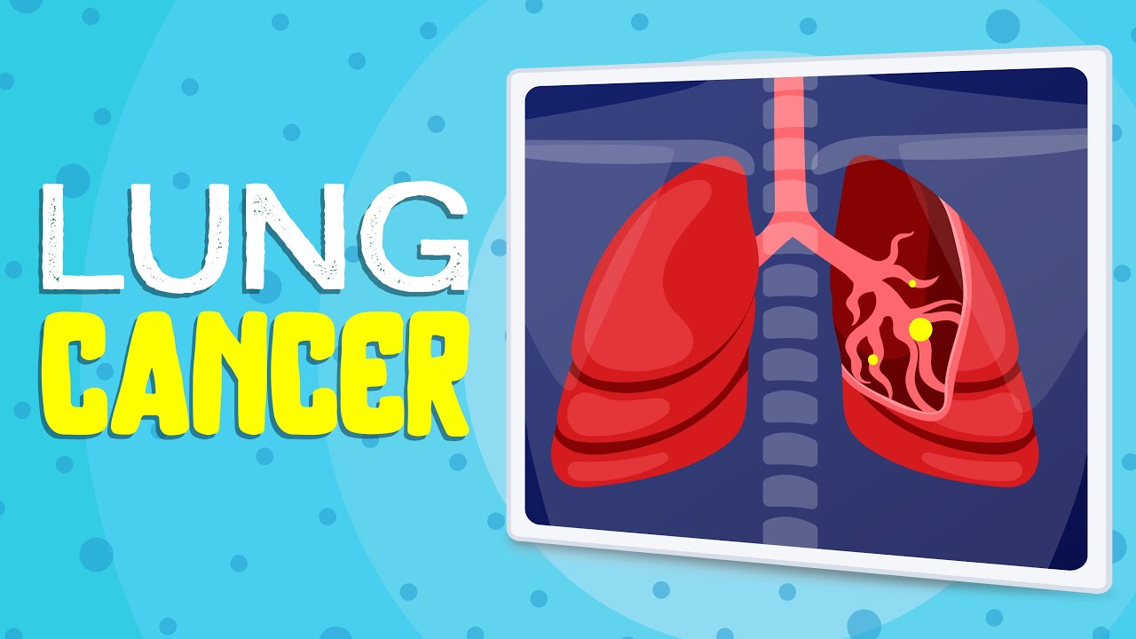 How to detect Lung cancer early? Lung cancer screening & prevention