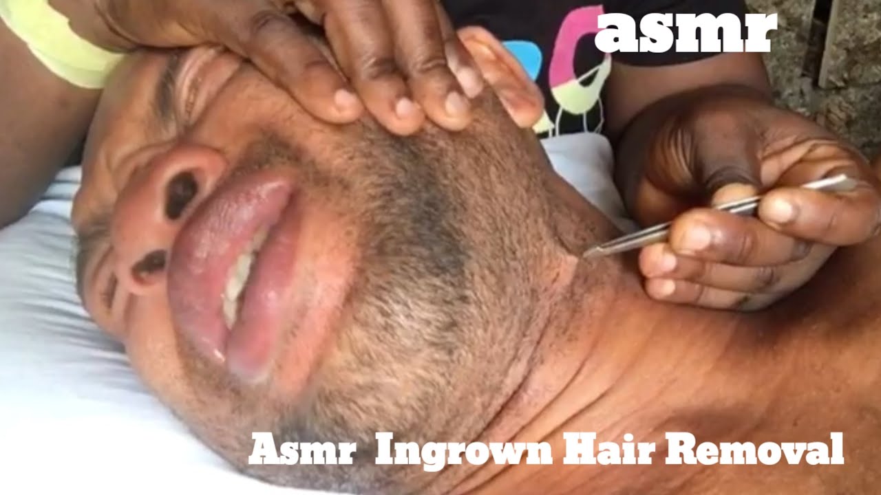Asmr✨️Ingrown Hair Removal for hubby to sleep 