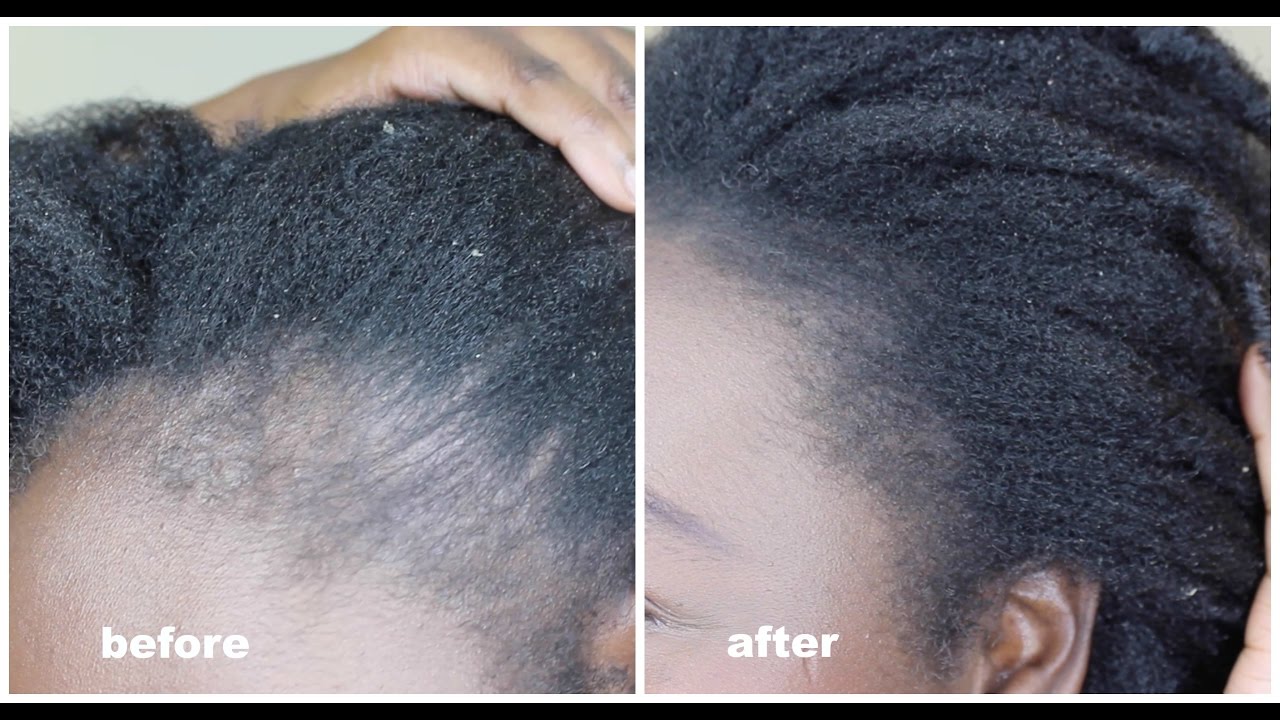 Instant Fix for a Thinning Hairline; 4C Natural hair