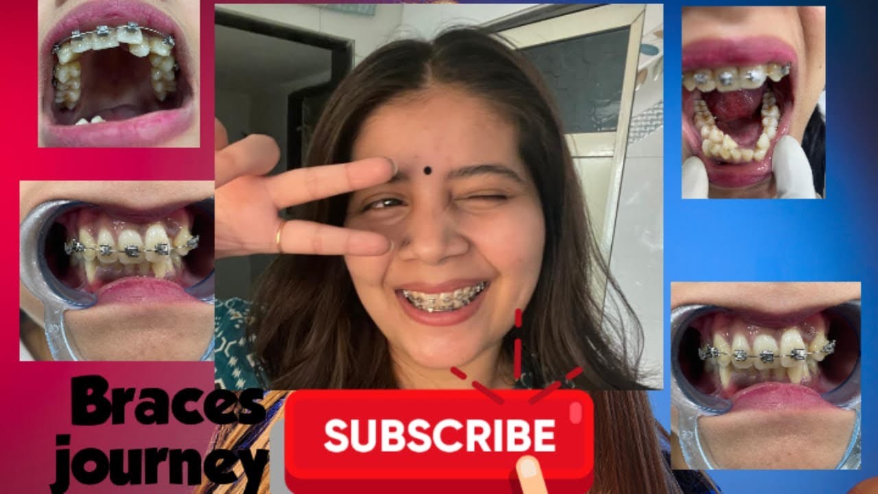 2026 में ब्रेसेस लगवाने का सोच रहे हो तो जान लो ये बात🥲#viral #dentist #trending #teeth #dentalcare 