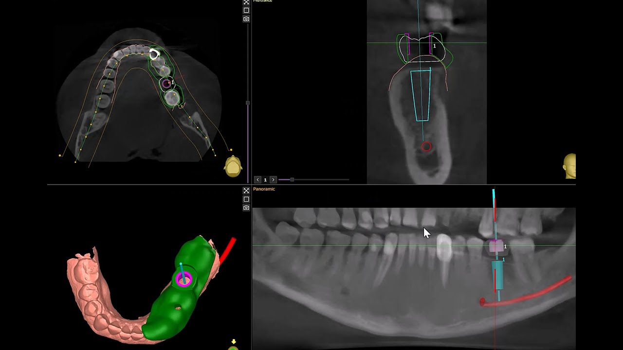 Simple Implant surgical guide with Implastation software (Arabic tutorial)