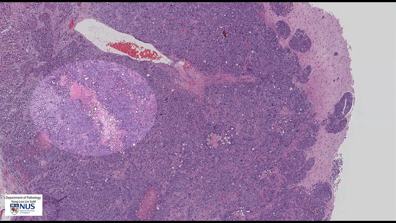 Brain, metastatic breast carcinoma microscopy - Talking slide