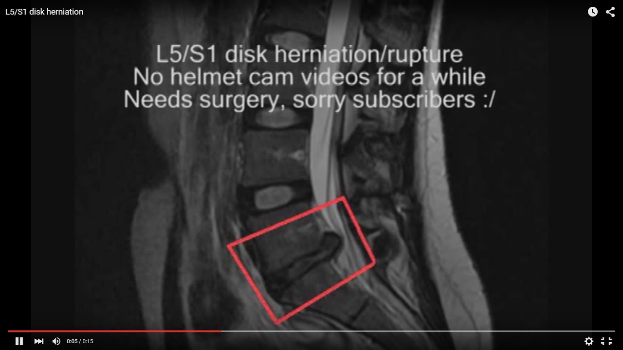ChixHealth: My Herniated Disk Lumbar Laminectomy Experience