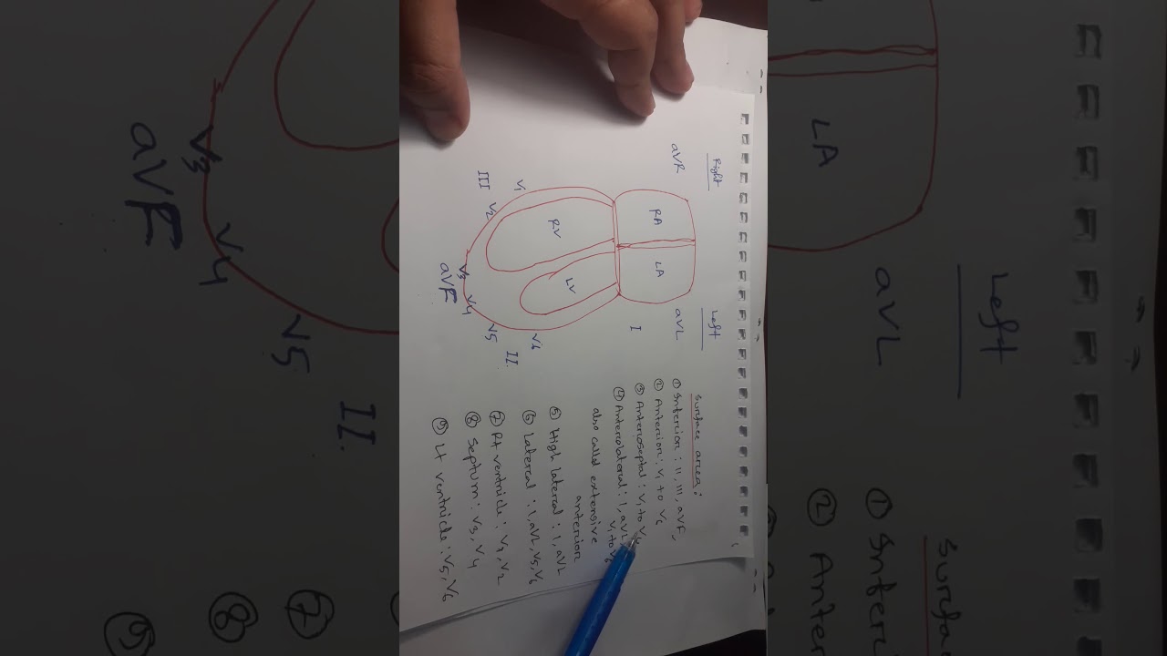 Clinical ECG Interpretation in Bangla (Part-5): Myocardial Infarction 2nd Part