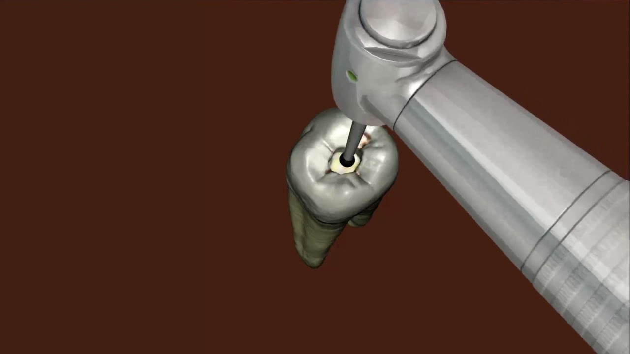 Simodont - Endodontics Procedure Video
