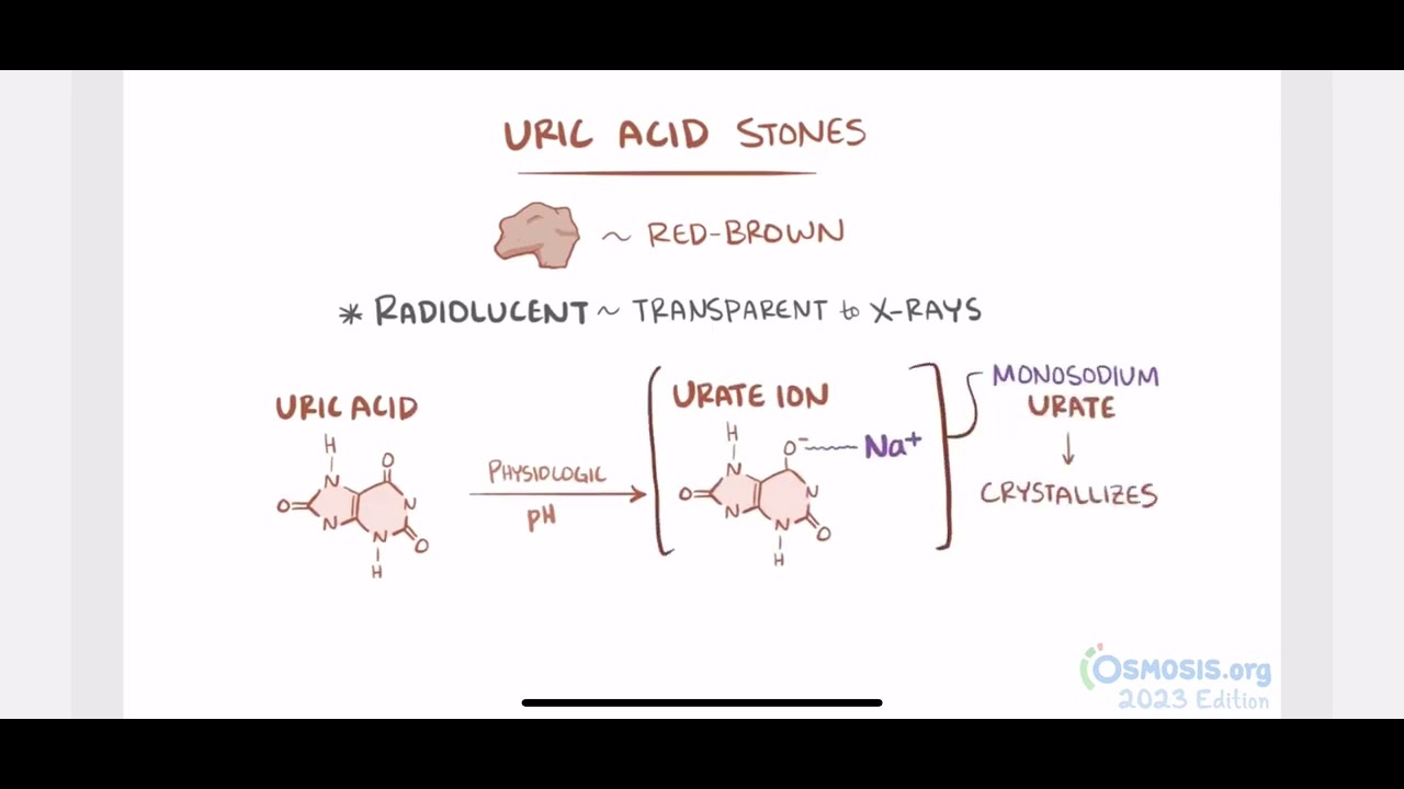 Renal stones from osmosis