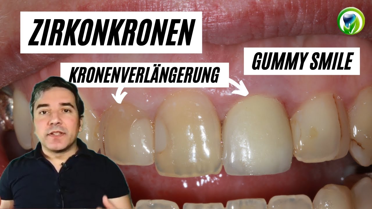 Vollverblendete Zirkonkronen im Frontzahnbereich - chirurgische Kronenverl&auml;ngerung beim Gummy Smile