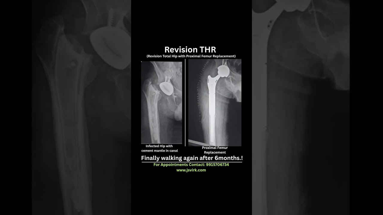 Revision Hip Replacement Surgery | Dr Jagandeep S Virk | Best Hip Replacement Surgeon in India