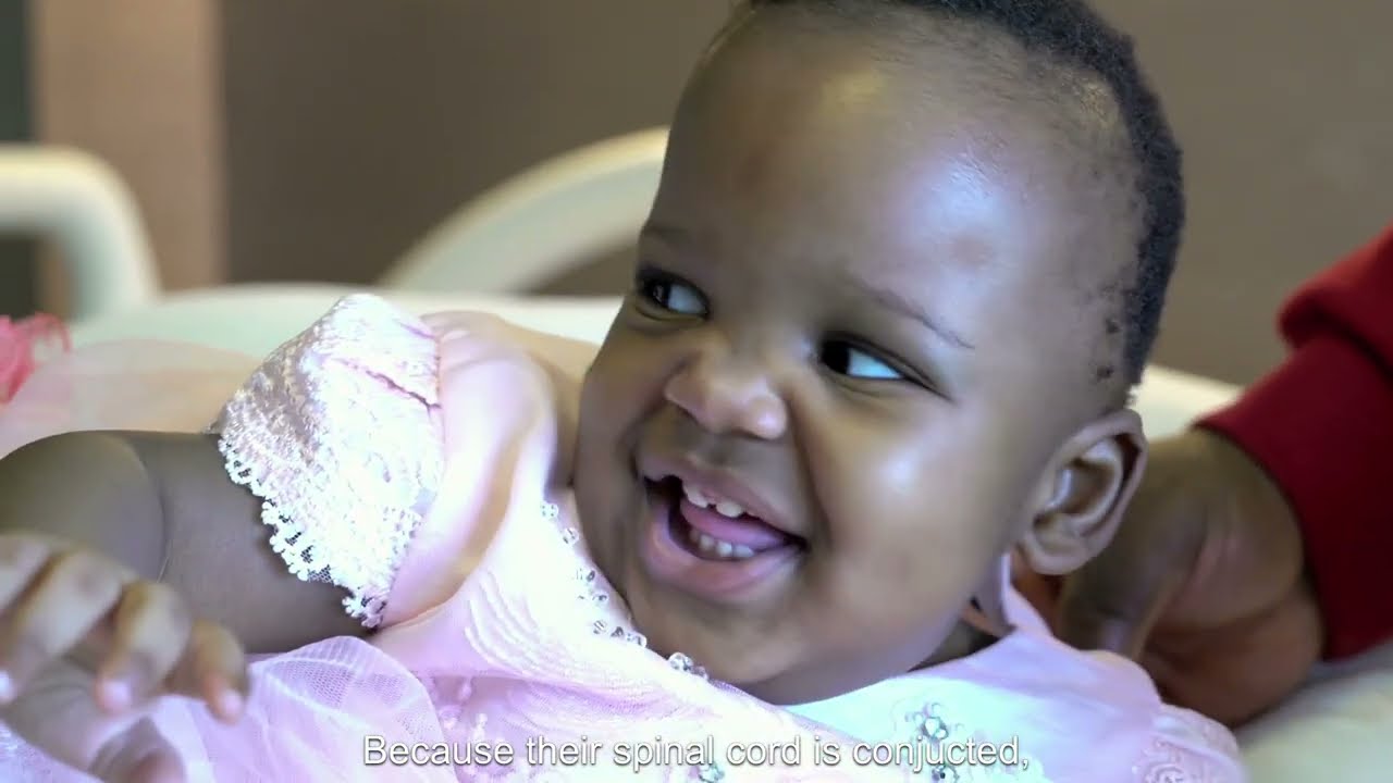 The Separation of Conjoined Twins Elizabeth and Mary (Conjoined Twins Documentary)
