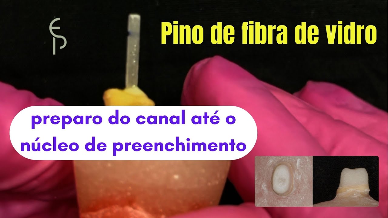 Pino de Fibra de Vidro Passo a Passo | Preparo, Cimentação e Núcleo com Resina