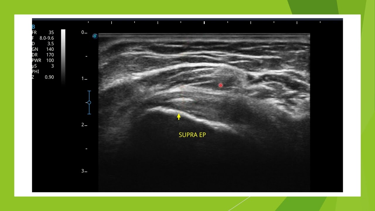 Clivage interstitiel du supra épineux en échographie