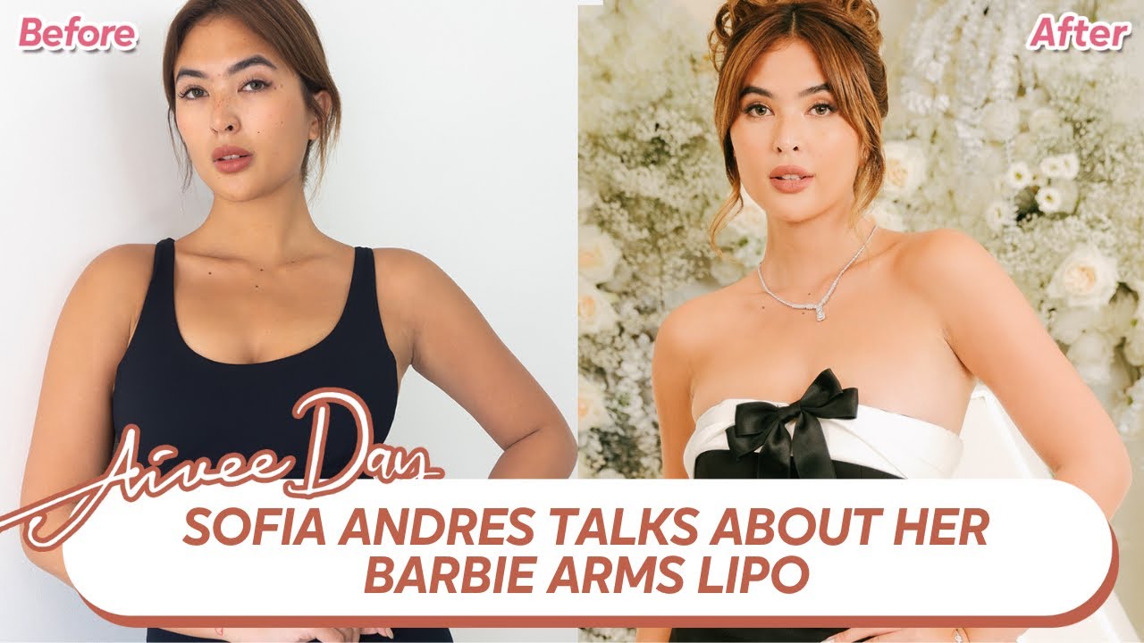 София Андрес рассказывает о своей липосакции Barbie Arms
