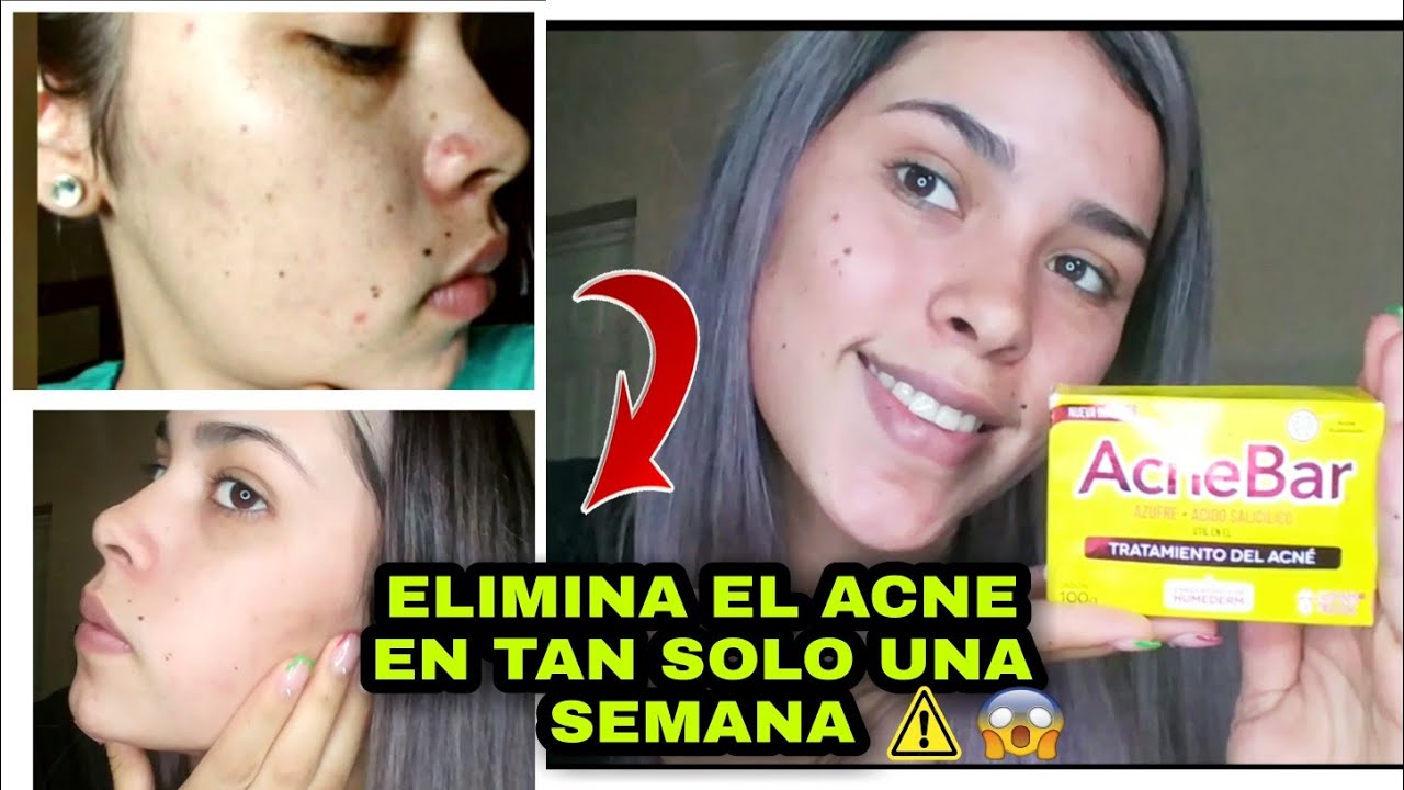 Como eliminar el acné? || Jabón de azufre para el acné😉 || Reseña