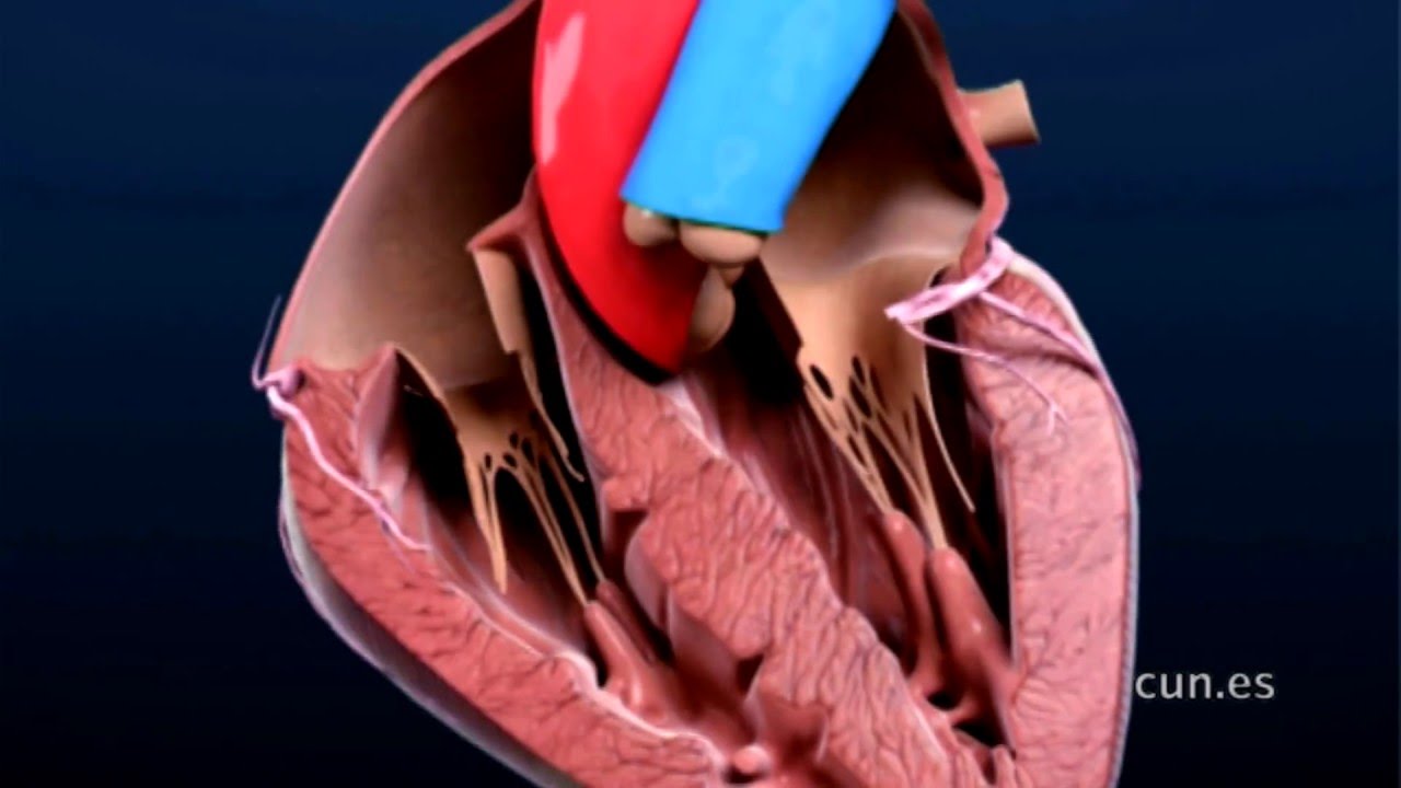 Crioablación, tratamiento de las arritmias cardiacas con frío