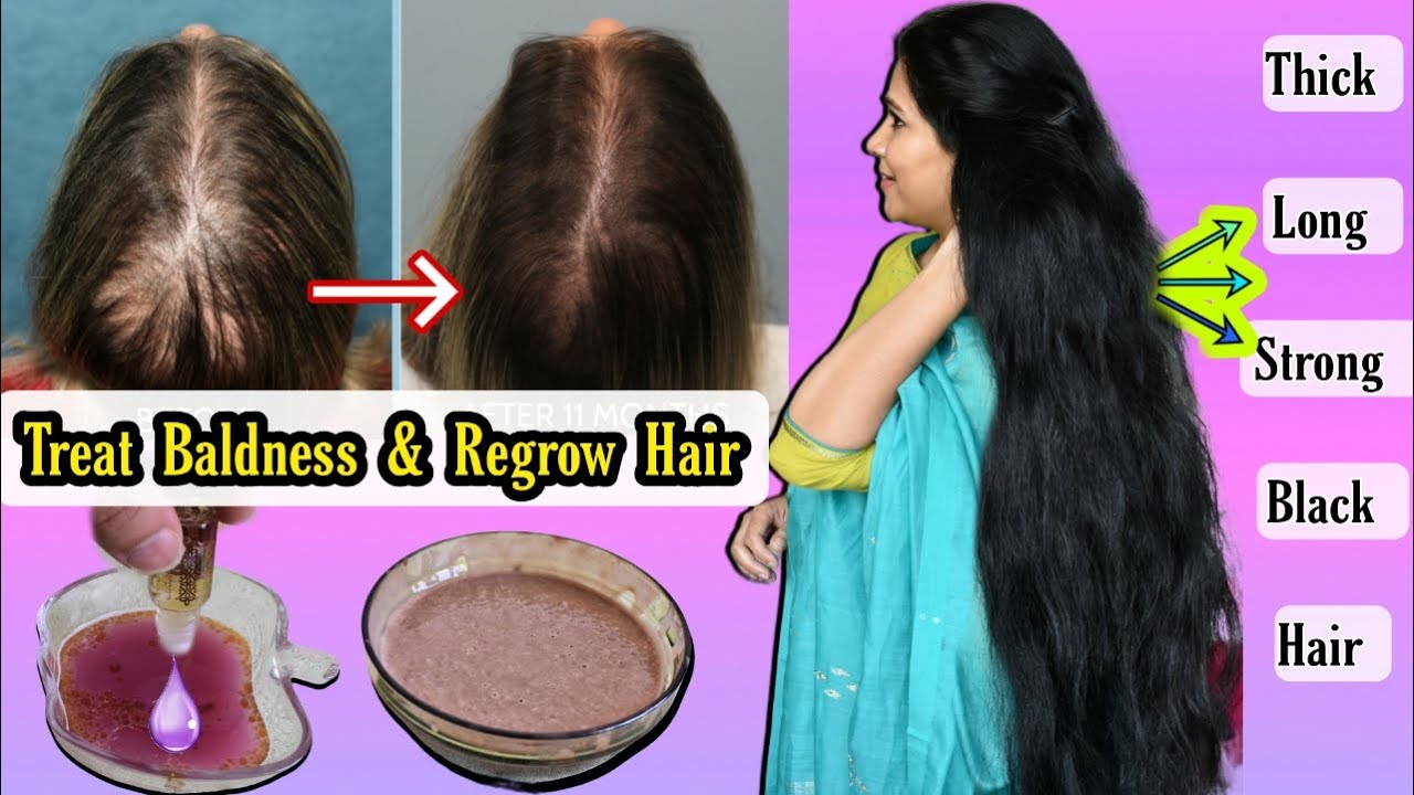Remedy Of Baldness & Hair Thinning,Regrow lost Hair गंजेपन की दवा जो बालों को झड़ने से रोके।