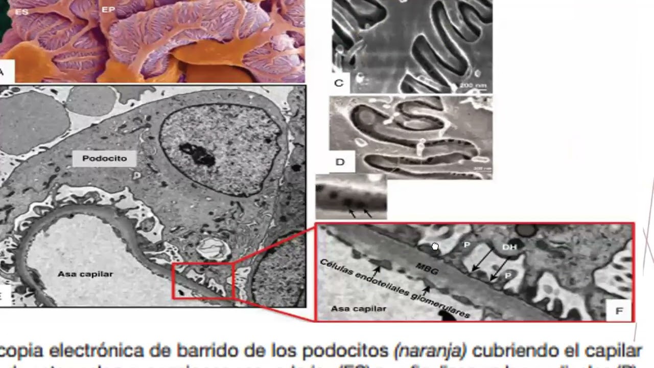 EL Podocito, Proteinuria y Albuminuria