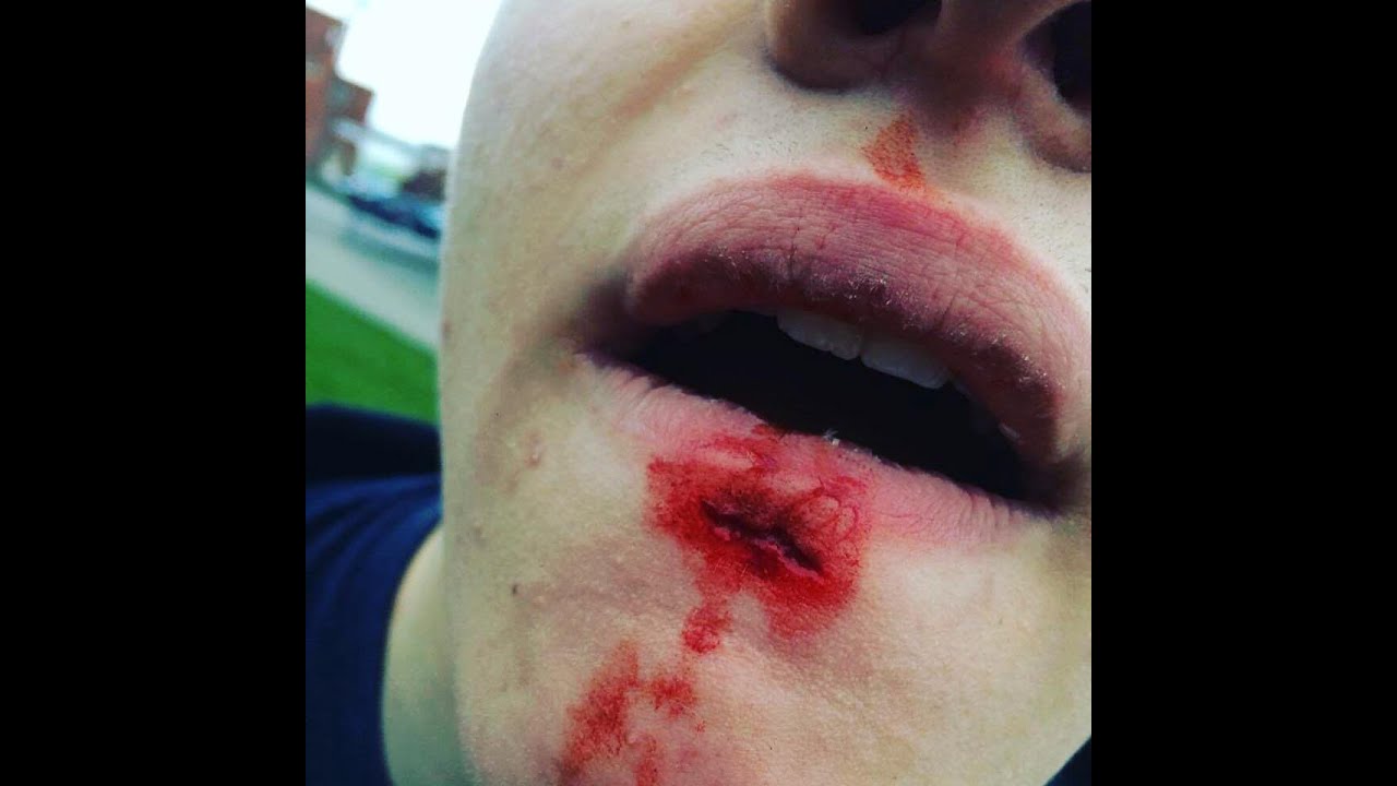 Vurtego V4 Pro (Fall Hospital) -Milton Clips ft -Alex Karim- Adam parry- James Davies